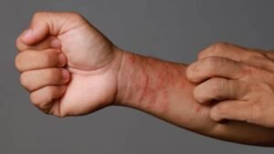 Managing Eczema Flare-Ups: Tips for Itchy, Dry Skin