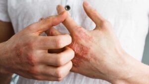 Managing Eczema Flare-Ups: Tips for Itchy, Dry Skin